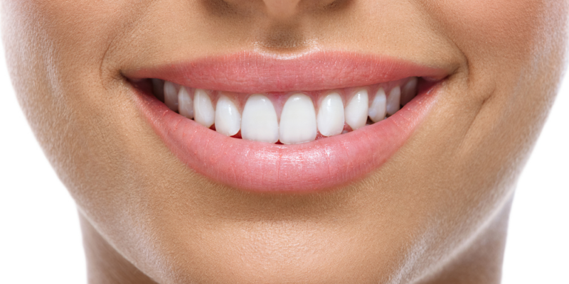 Dental Veneers